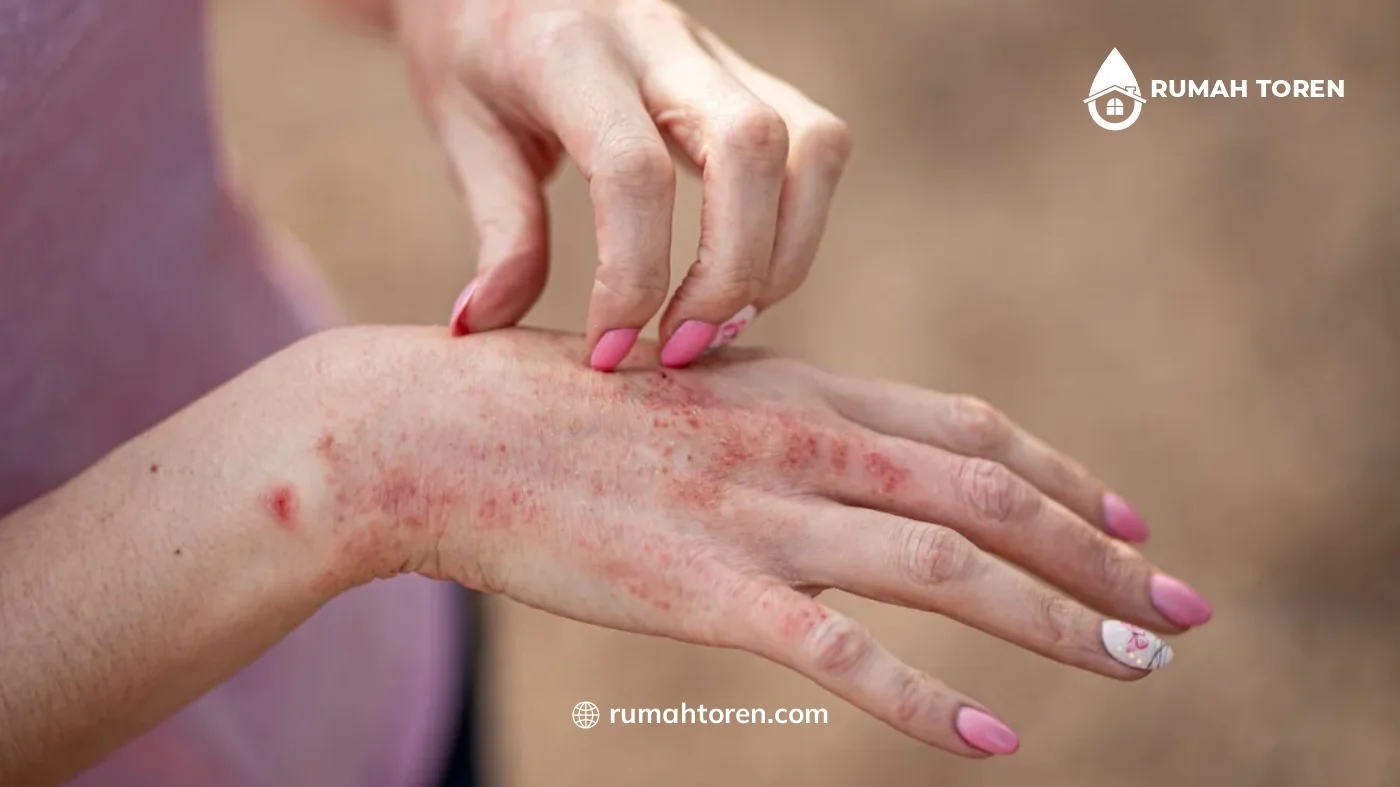 Inilah Hubungan Antara Toren Kotor dan Masalah Kesehatan Kulit